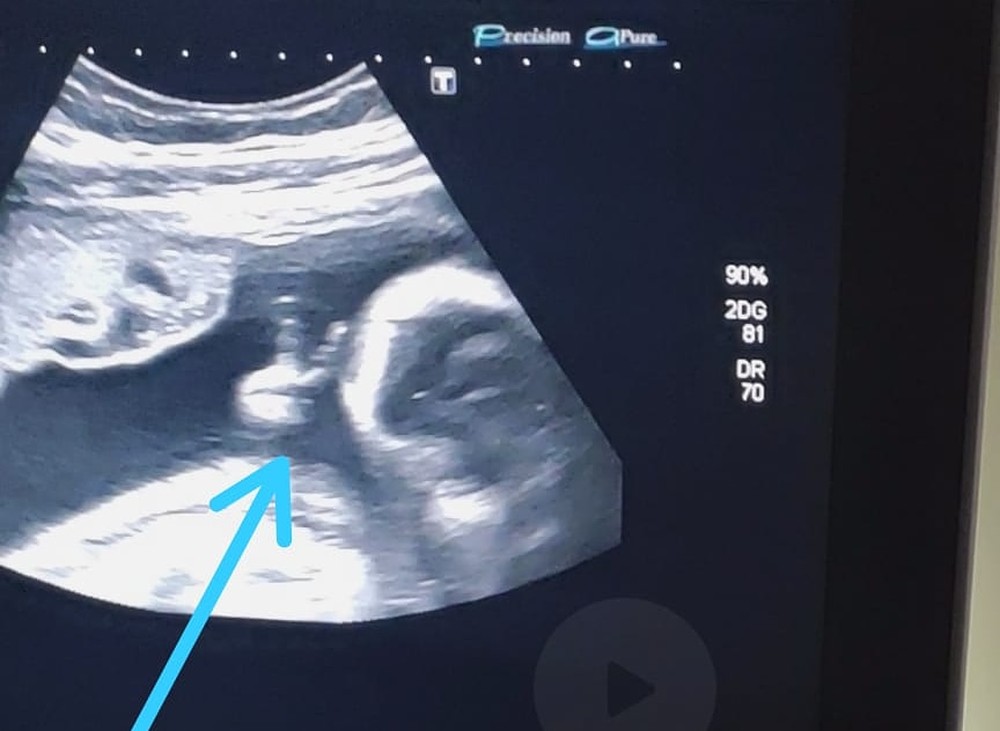 Photo of Bebê faz ‘V de vitória’ durante ultrassom e pai com câncer raro vê sinal divino: ‘Mais força’