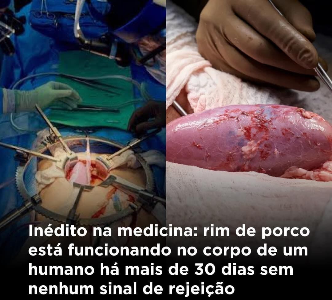 Photo of Pela primeira vez, rim de porco transplantado para um ser humano fornecem função de manutenção da vida