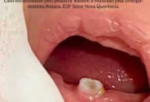 Photo of Exodontia em bebê de 15 dias chama atenção em Querência por raridade do caso
