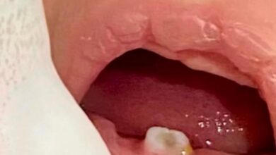 Photo of Exodontia em bebê de 15 dias chama atenção em Querência por raridade do caso